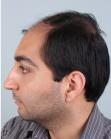 Before Hair Transplant&nbsp;Front